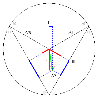 Vektor im Einthoven-Dreieck