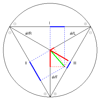 Vektor im Einthoven-Dreieck