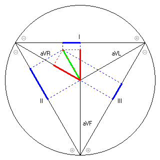 Vektor im Einthoven-Dreieck