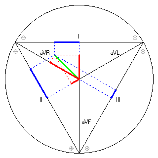 Vektor im Einthoven-Dreieck