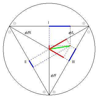 Vektor im Einthoven-Dreieck