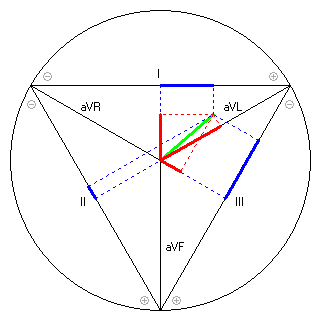 Vektor im Einthoven-Dreieck