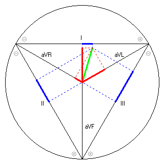 Vektor im Einthoven-Dreieck