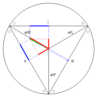 Vektor im Einthoven-Dreieck