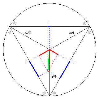 Vektor im Einthoven-Dreieck