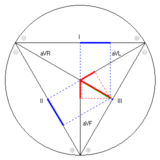 Vektor im Einthoven-Dreieck