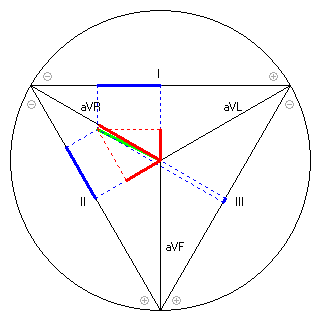 Vektor im Einthoven-Dreieck