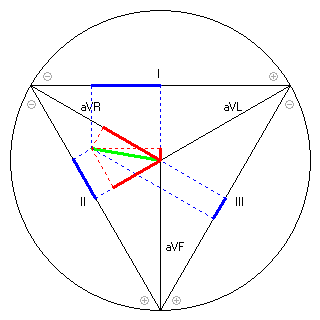 Vektor im Einthoven-Dreieck