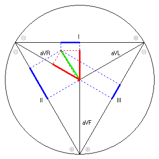 Vektor im Einthoven-Dreieck