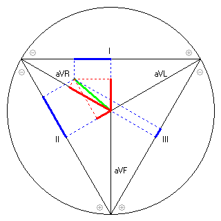 Vektor im Einthoven-Dreieck