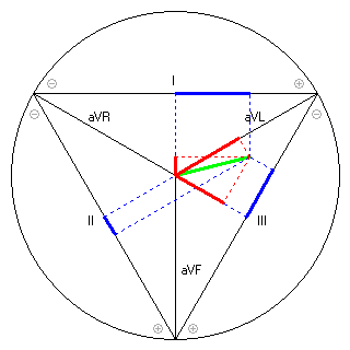 Vektor im Einthoven-Dreieck