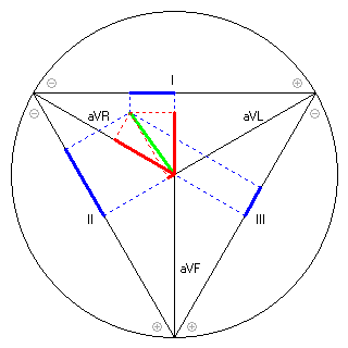 Vektor im Einthoven-Dreieck