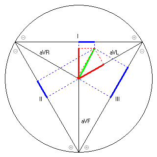 Vektor im Einthoven-Dreieck