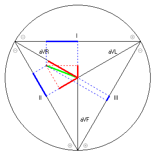 Vektor im Einthoven-Dreieck