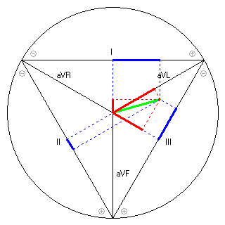 Vektor im Einthoven-Dreieck