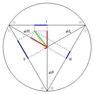 Vektor im Einthoven-Dreieck