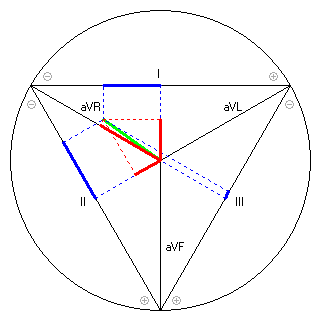 Vektor im Einthoven-Dreieck