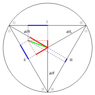 Vektor im Einthoven-Dreieck