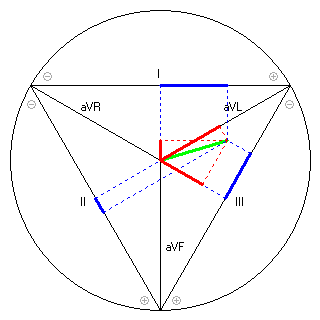 Vektor im Einthoven-Dreieck