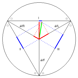 Vektor im Einthoven-Dreieck