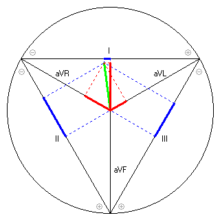 Vektor im Einthoven-Dreieck