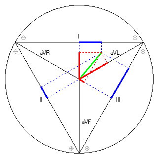 Vektor im Einthoven-Dreieck