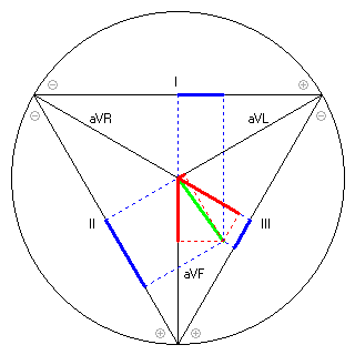 Vektor im Einthoven-Dreieck