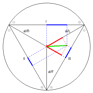 Vektor im Einthoven-Dreieck