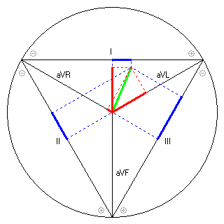 Vektor im Einthoven-Dreieck