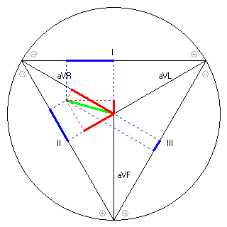 Vektor im Einthoven-Dreieck