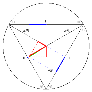 Vektor im Einthoven-Dreieck