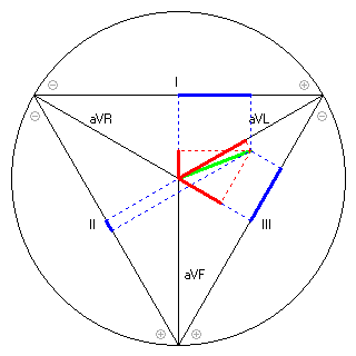 Vektor im Einthoven-Dreieck