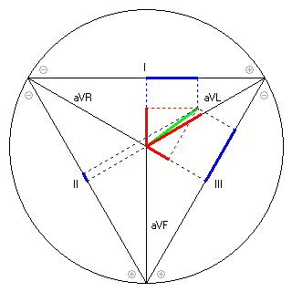 Vektor im Einthoven-Dreieck