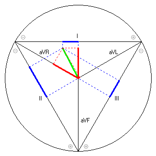 Vektor im Einthoven-Dreieck