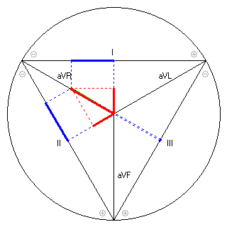 Vektor im Einthoven-Dreieck