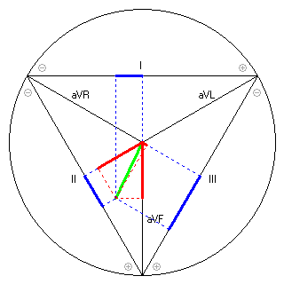 Vektor im Einthoven-Dreieck