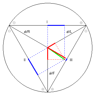 Vektor im Einthoven-Dreieck