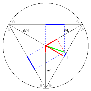 Vektor im Einthoven-Dreieck