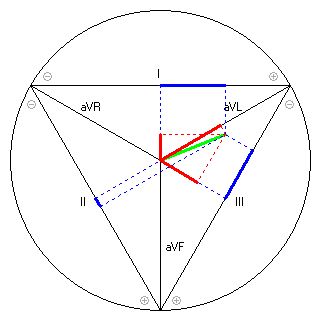 Vektor im Einthoven-Dreieck