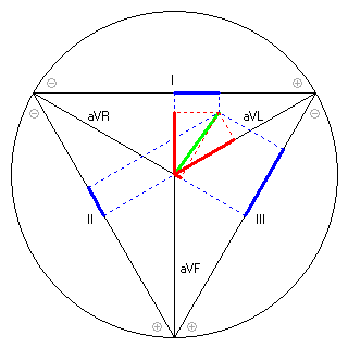 Vektor im Einthoven-Dreieck