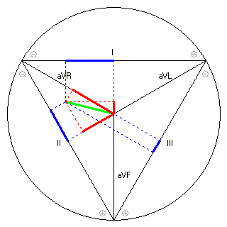 Vektor im Einthoven-Dreieck