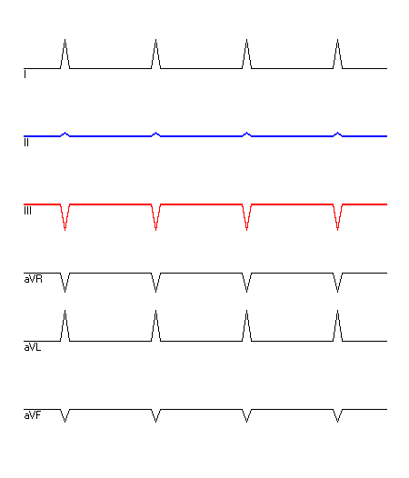 EKG mit hervorgehobenen Ableitungen