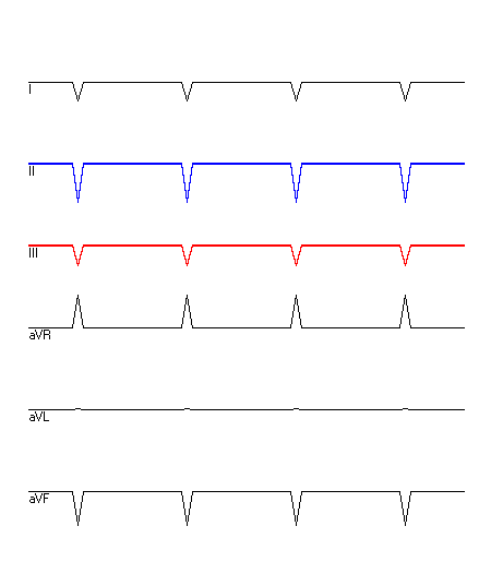 EKG mit hervorgehobenen Ableitungen