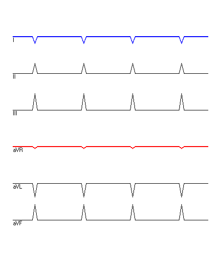 EKG mit hervorgehobenen Ableitungen