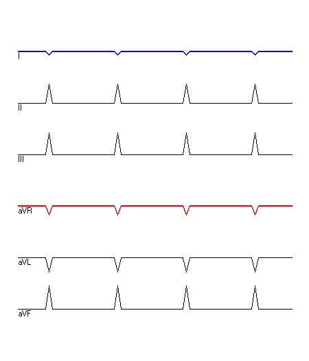 EKG mit hervorgehobenen Ableitungen