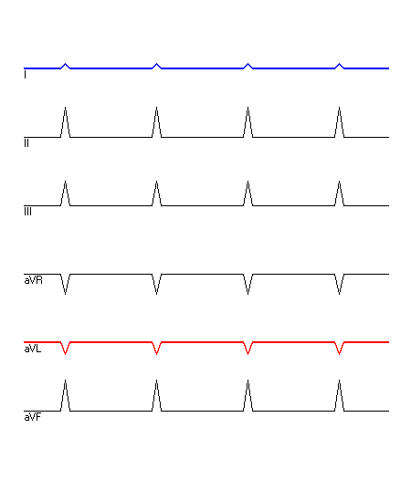 EKG mit hervorgehobenen Ableitungen