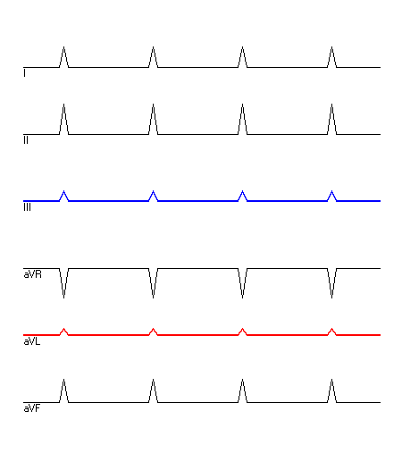 EKG mit hervorgehobenen Ableitungen