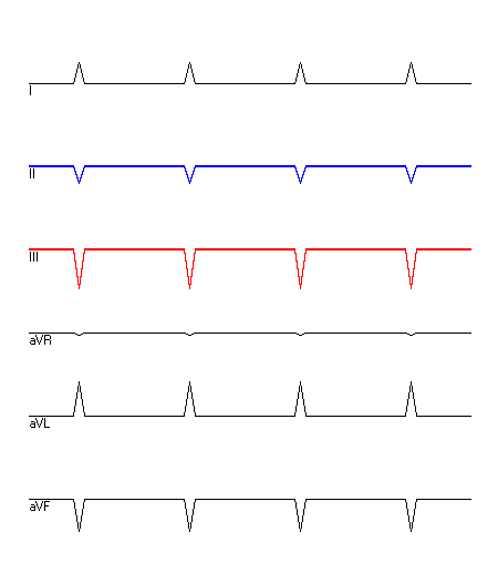 EKG mit hervorgehobenen Ableitungen