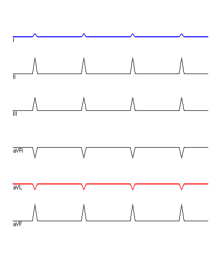 EKG mit hervorgehobenen Ableitungen