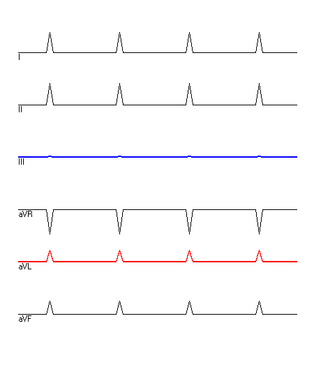 EKG mit hervorgehobenen Ableitungen